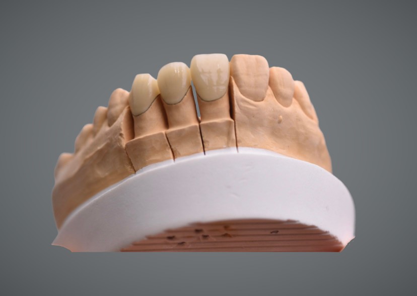 Porcelain Fused to Zirconia (PFZ)