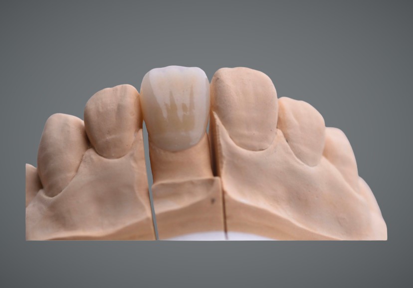 IPS e.max Pressed Aesthetic Crown