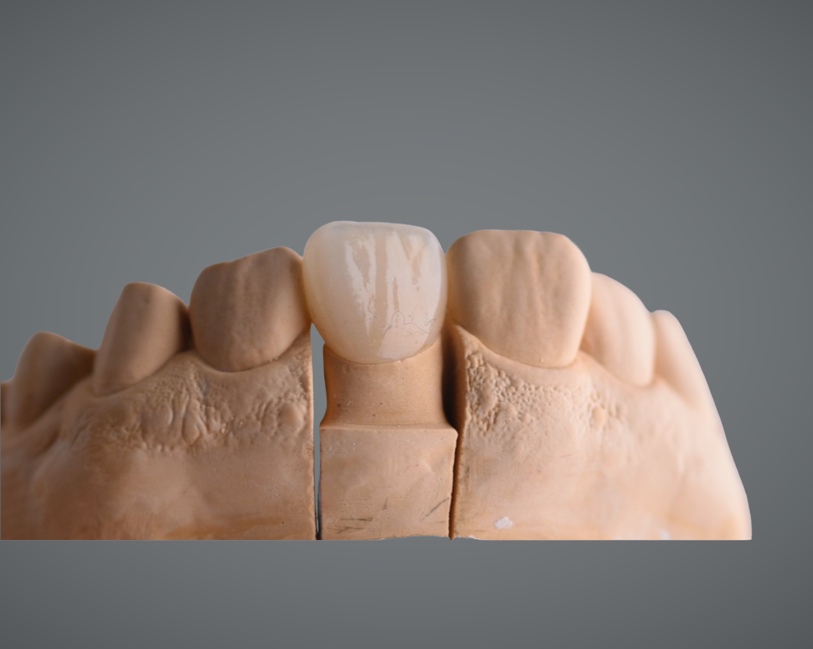 IPS e.max Pressed and Layered Aesthetic Crown
